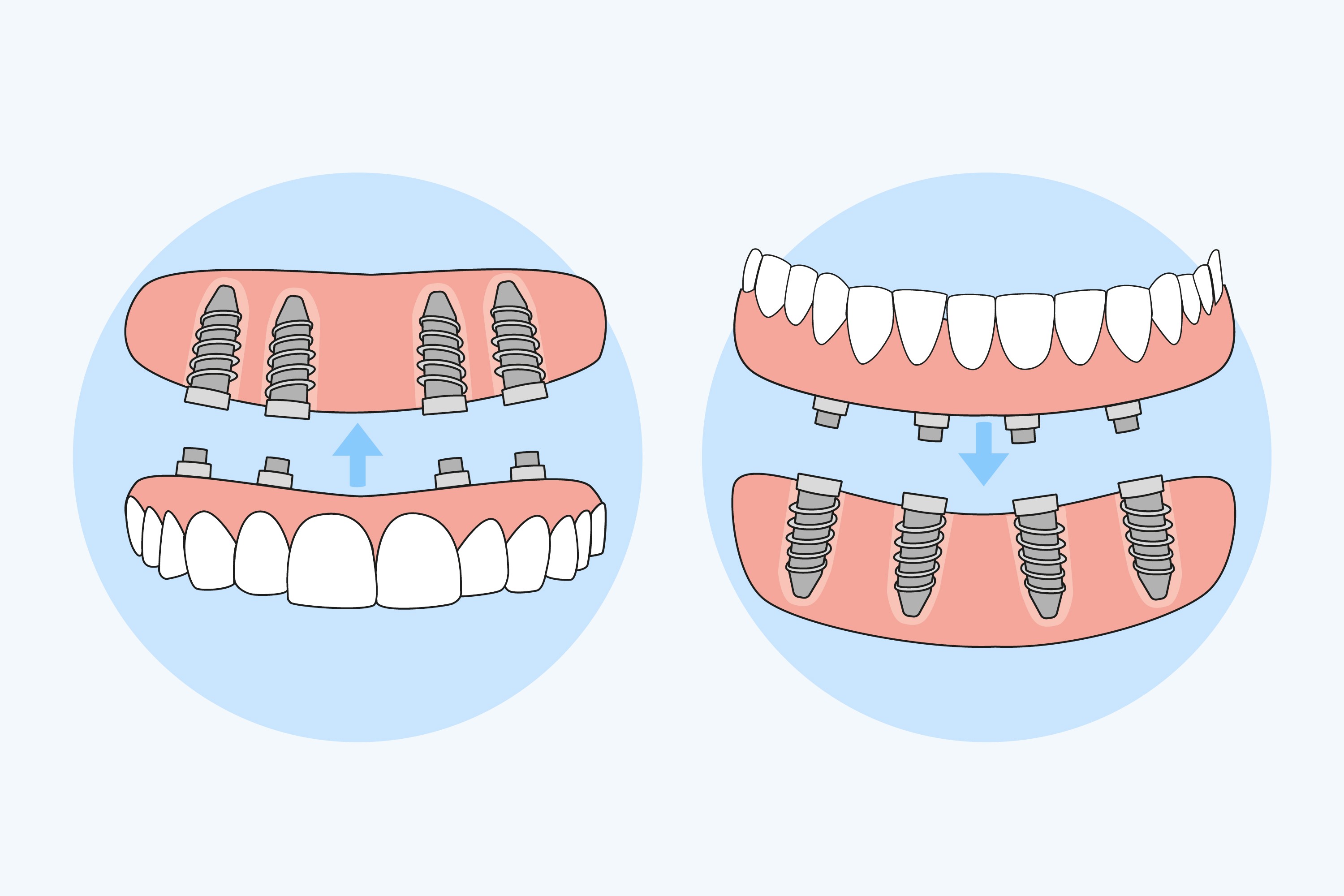 Отсутствие зубов — первичная и вторичная адентия